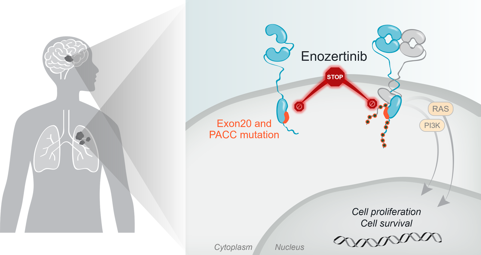 CEGFR exon 20 cancer with brain metastases