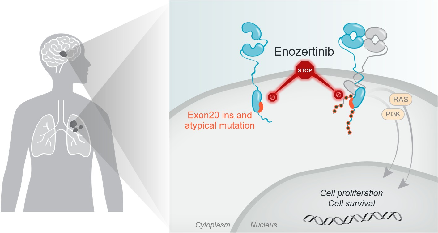 EGFR mutated NSCLC with brain metastases